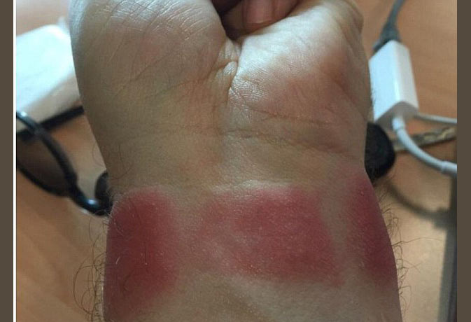 Apple Watch Burnt My Wrist Mother Of Two Left With Painful Welts After £300  Gadget Overheated In The Sun And Was Told By Technology Giant She Must Be  Wearing It Wrong- सावधान!
